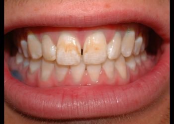 An Easy Way to Remove Tooth Stains