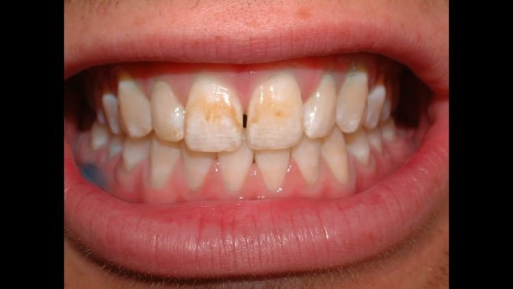 An Easy Way to Remove Tooth Stains