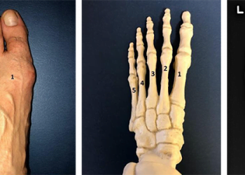 Toe and Metatarsal Fractures