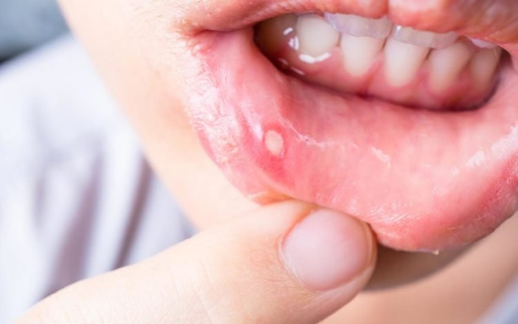 7 Ways to Take Care of Your Cold Sore