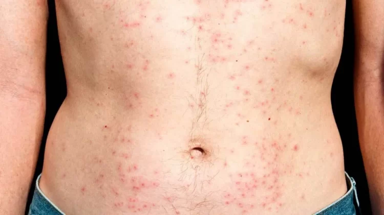 How to Protect Your Skin from Chlorine and Saltwater