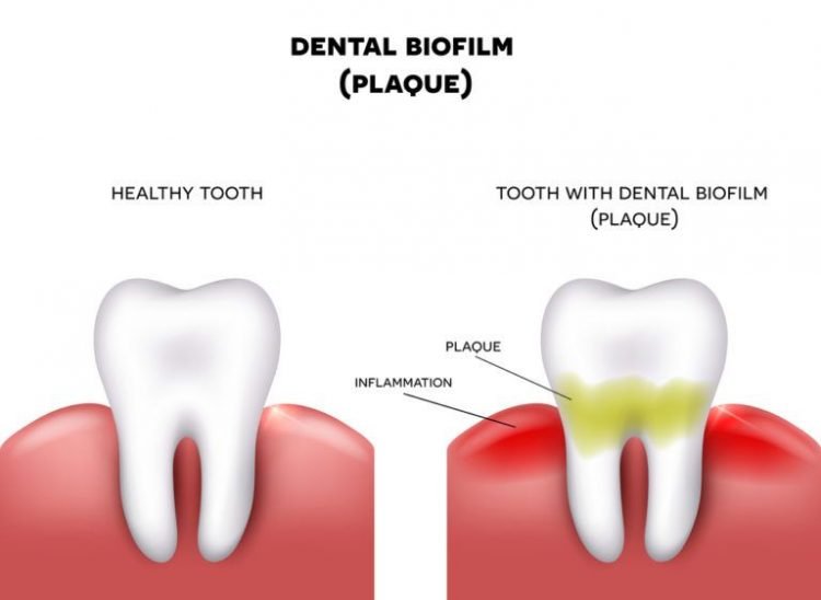 DENTAL BIOFILM: WHAT IS IT, AND HOW IS IT PREVENTED?