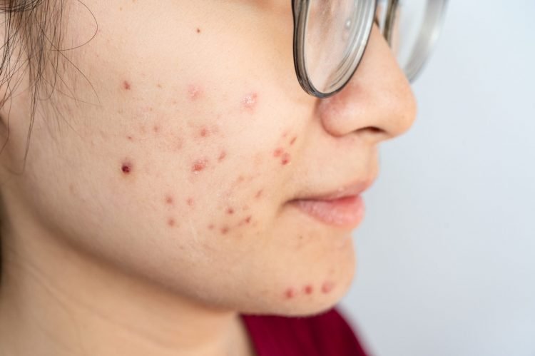 Anybody Dealing With Both Eczema and Acne; Any Recommendations?
