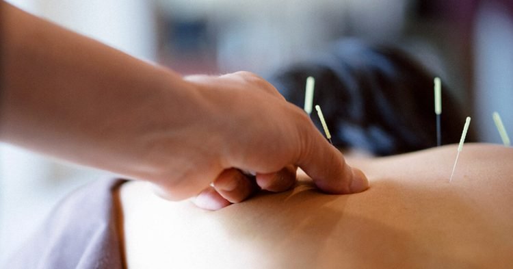 Discover How Acupuncture Can Help You Lose Weight