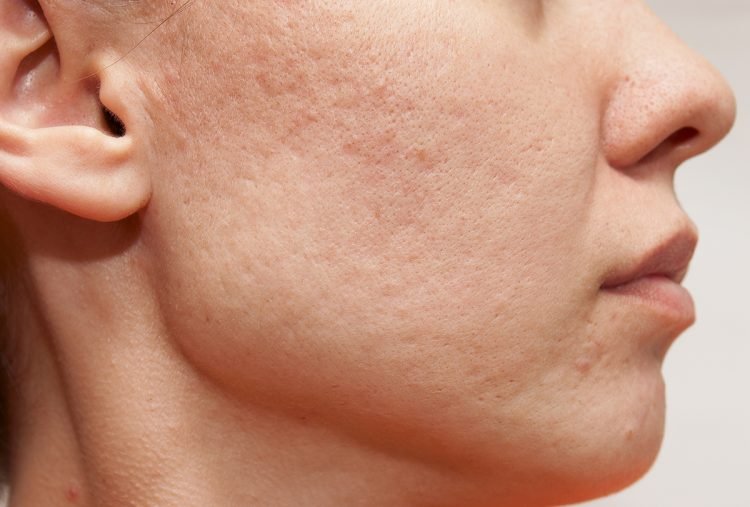 At-Home Remedies for Blemishes