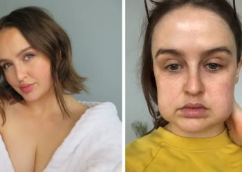 3 Things to Consider After Bichectomy