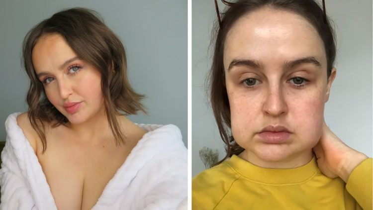 3 Things to Consider After Bichectomy