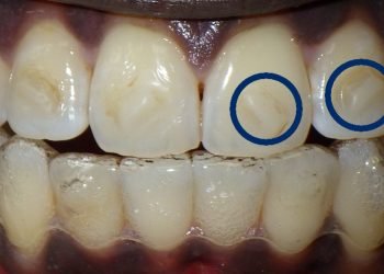 What Clear Aligners Attachments Are and When They Should Be Used?