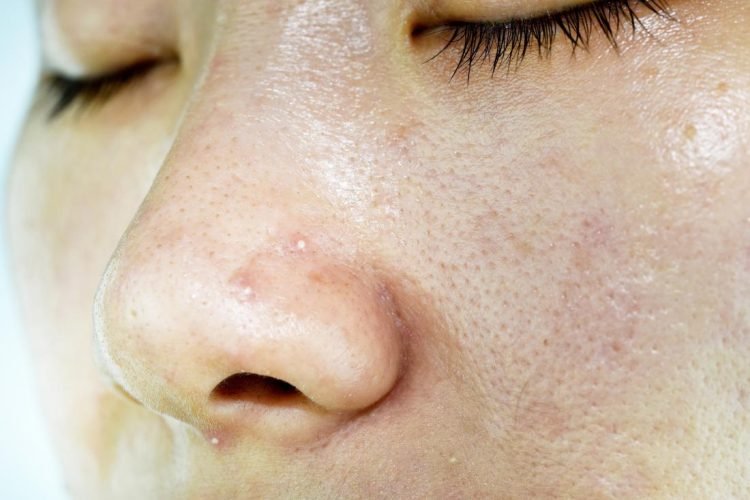 How to Treat and Prevent Acne On Oily Skin