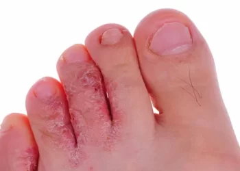 Everything you need to know about Athlete’s foot – Identify & treat it