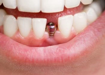 What to Expect from a Cosmetic and Implant Dentistry Procedure