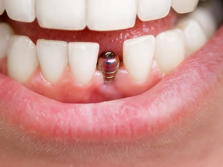 What to Expect from a Cosmetic and Implant Dentistry Procedure