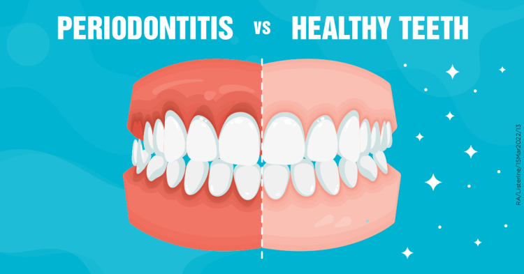 The Importance of Gum Health: Understanding and Preventing Gingivitis