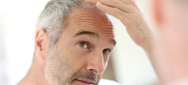 Hair Loss and Aging: Navigating the Changes with Grace