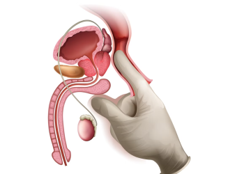 Vasectomy reversal: Understanding the process and purpose