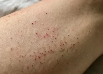 From Flaking to Smooth: Tips on How to Shave Ingrown Hairs and Razor Bumps