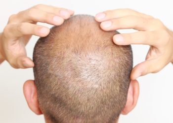 Navigating Life Beyond the First Year of Your Hair Transplant