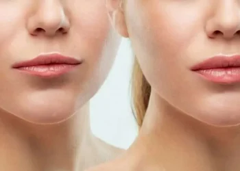 Navigating The Cost Landscape Of Lip Fillers In Chicago