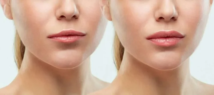 Navigating The Cost Landscape Of Lip Fillers In Chicago
