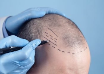 Turkey Hair Transplant Cost in 2024 Revealed