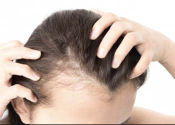 Hair Loss in Women: Common Causes and How to Stop It