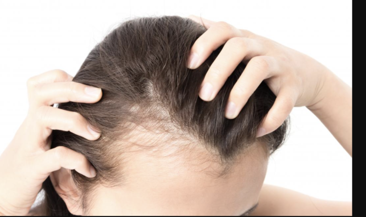 Hair Loss in Women: Common Causes and How to Stop It