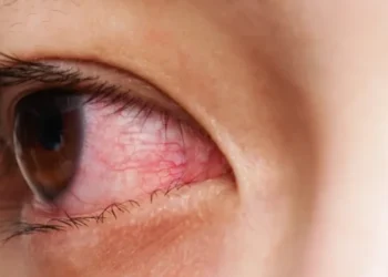 Which are the Most Common Eye Conditions