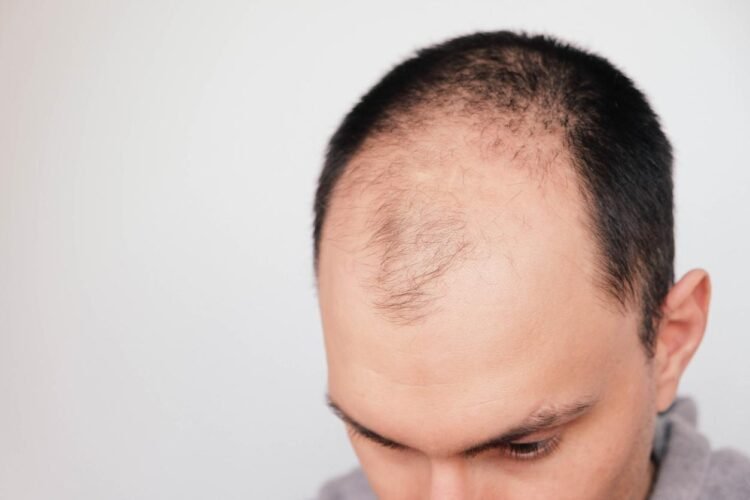 Understanding the Norwood Scale: Stages of Male Pattern Baldness