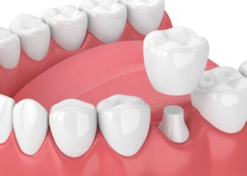 How CEREC is Streamlining Dental Crown Creation