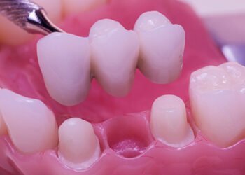 Missing Teeth: Do You Really Need to Replace Them?