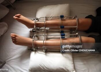 Are Your Legs Weaker After Leg Lengthening