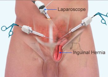 Laparoscopic vs. Open Hernia Surgery – Which Is Right for You?