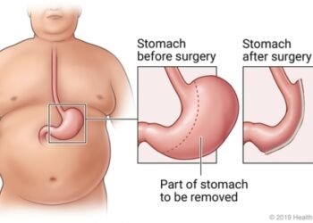 Gastric Sleeve Surgery – What to Expect Before, During, and After