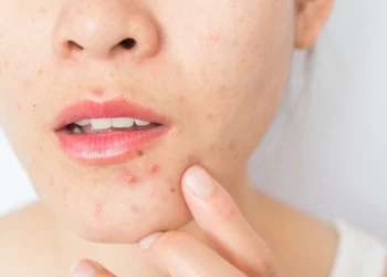 Why Monsoon Humidity Is Your Acne Trigger (and What to Do About It)