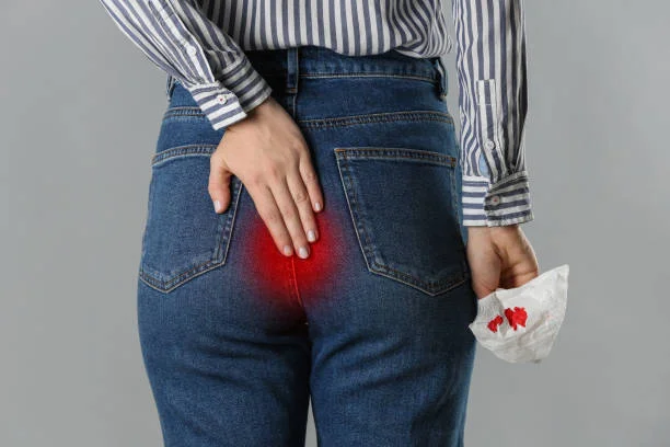 Say Goodbye to Discomfort: Best Home Remedies for Hemorrhoids