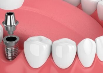 How Long Do Dental Implants Last? A Guide to Longevity