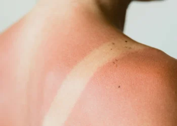 I Forgot Sunscreen – Here’s What Gave Me Sunburn Relief