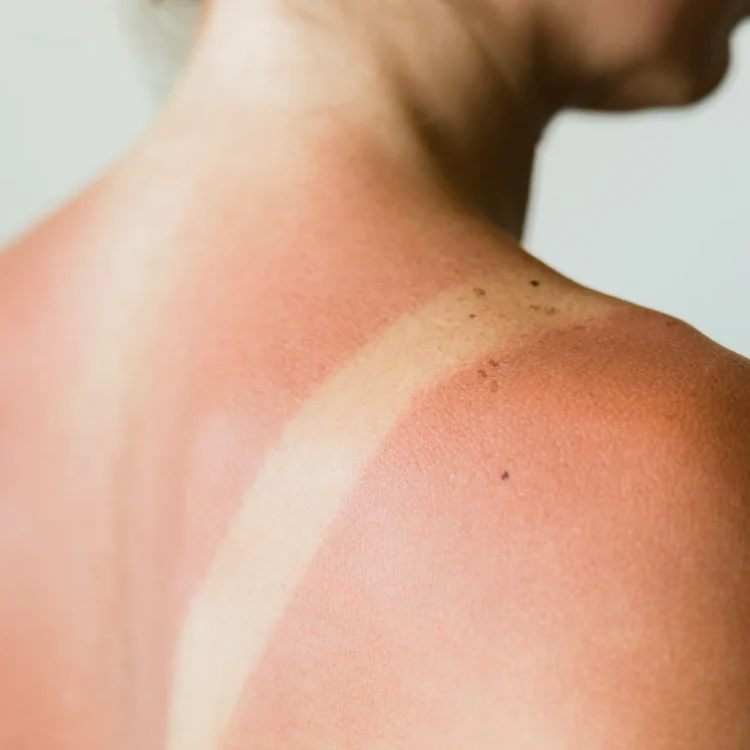 I Forgot Sunscreen – Here’s What Gave Me Sunburn Relief
