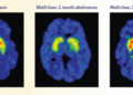 What Actually Makes Addiction Treatment Work: A Look at the Research