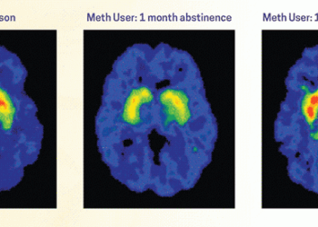 What Actually Makes Addiction Treatment Work: A Look at the Research